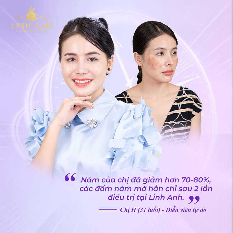 Hình ảnh chị H trước và sau khi điều trị nám tại Linh Anh