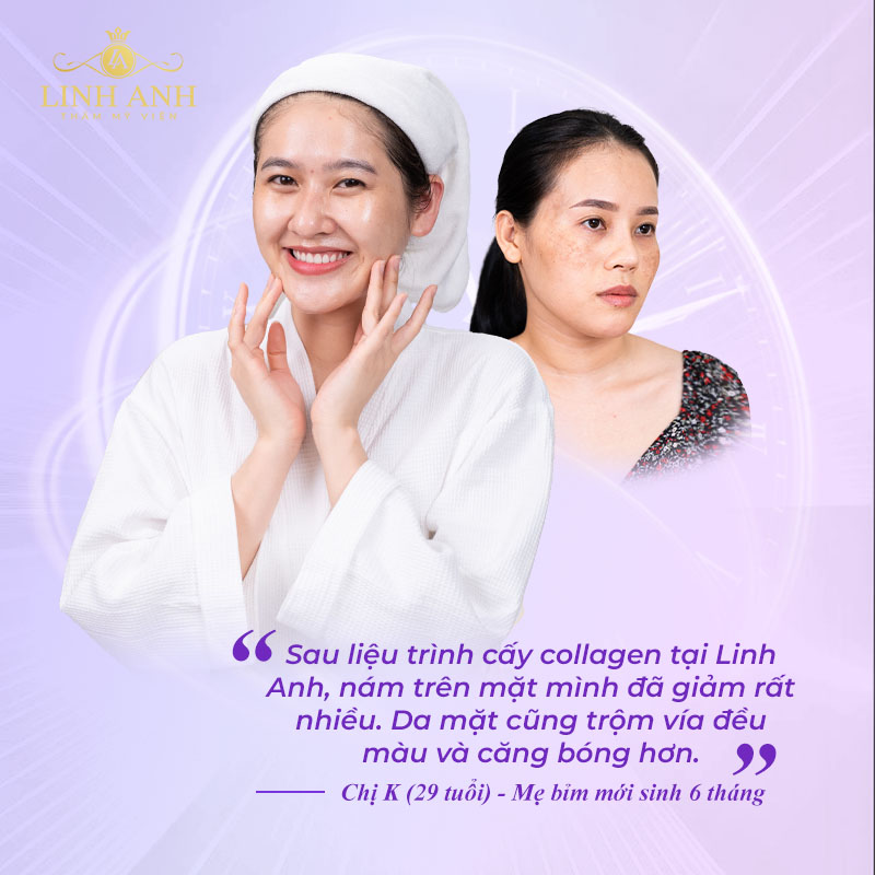 Chị K sử dụng liệu trình cấy collagen tại Linh Anh