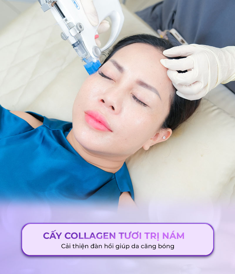 cấy collagen tươi trị nám