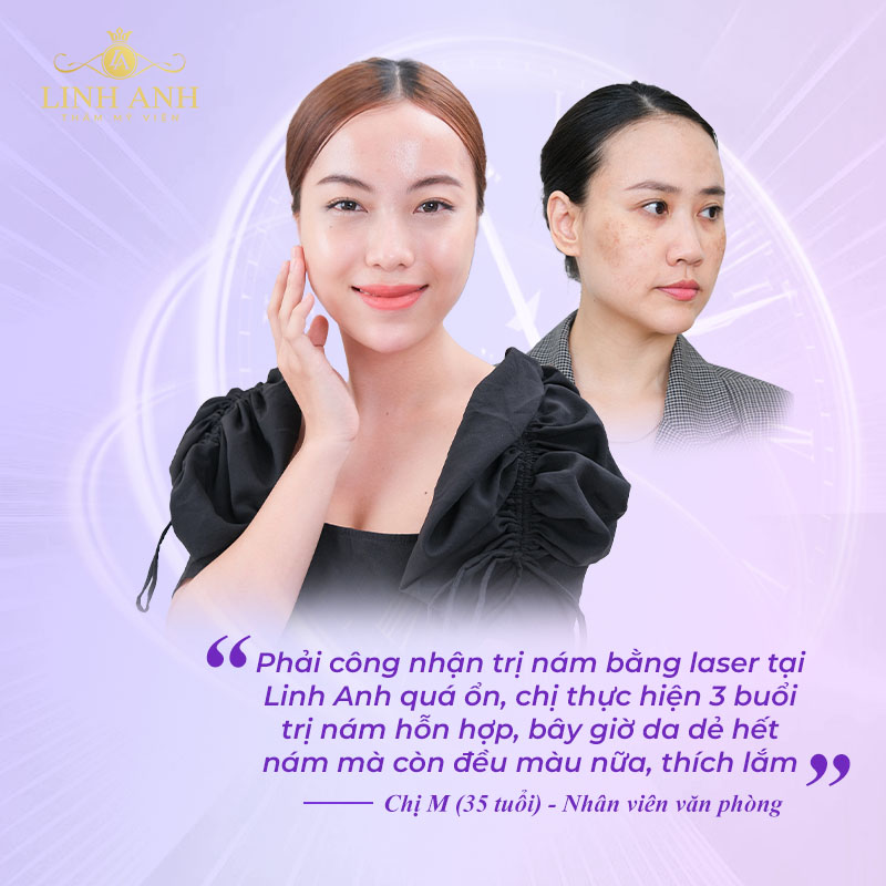 Chị M sử dụng công nghệ trị nám bằng laser tại Linh Anh