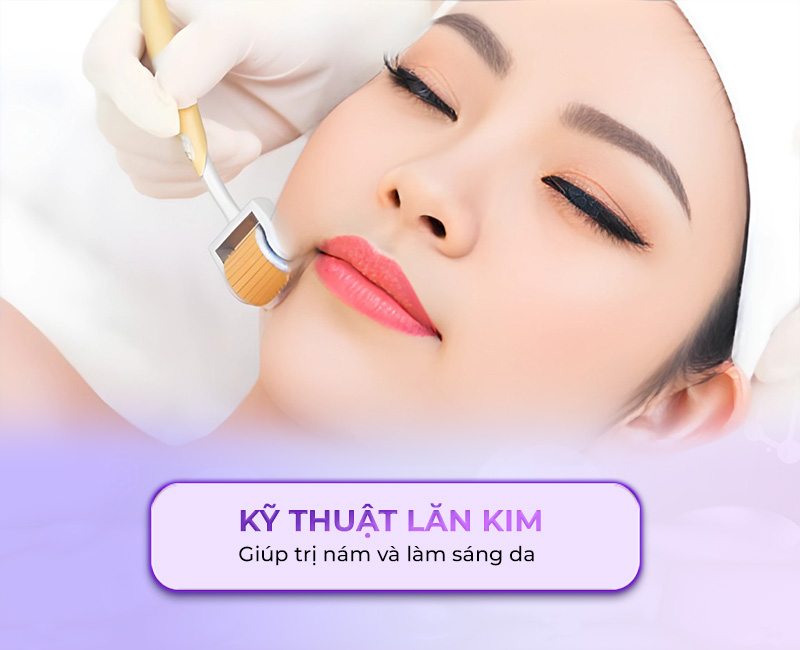 trị nám bằng cách lăn kim