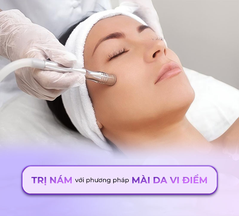 trị nám bằng phương pháp mài da vi điểm