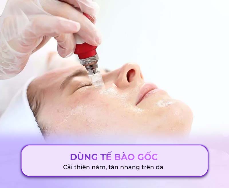dùng tế bào gốc trị nám