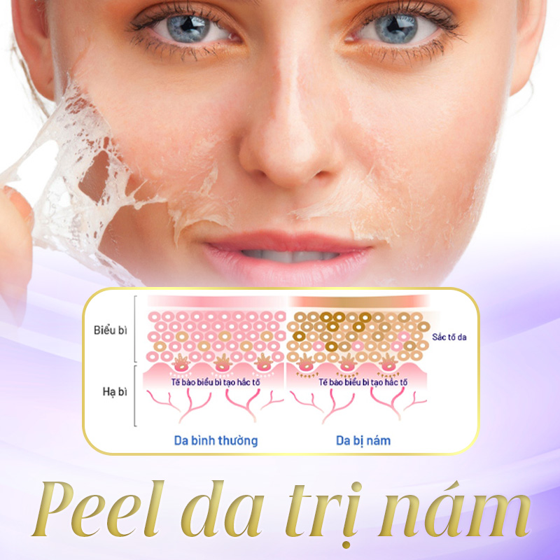 trị nám bằng phương pháp peel da