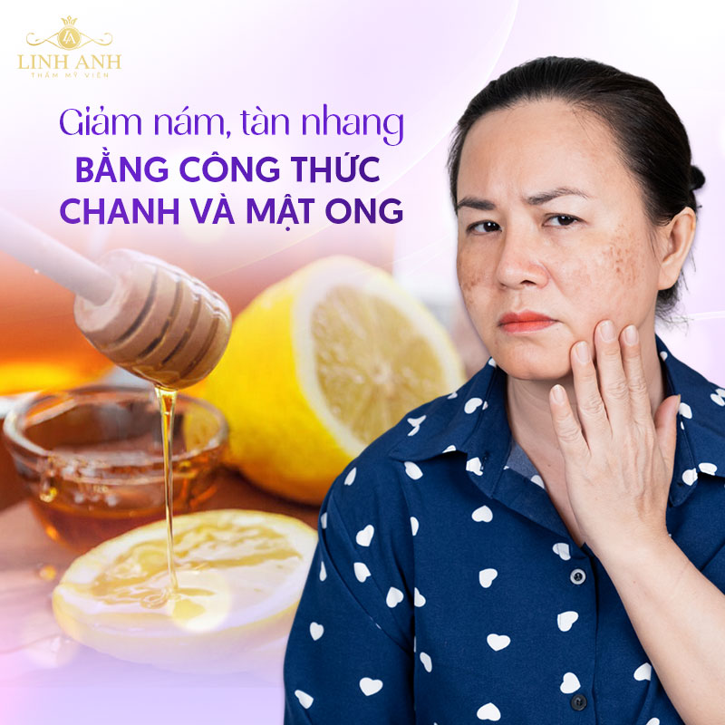 Cách trị nám bằng chanh và mật ong