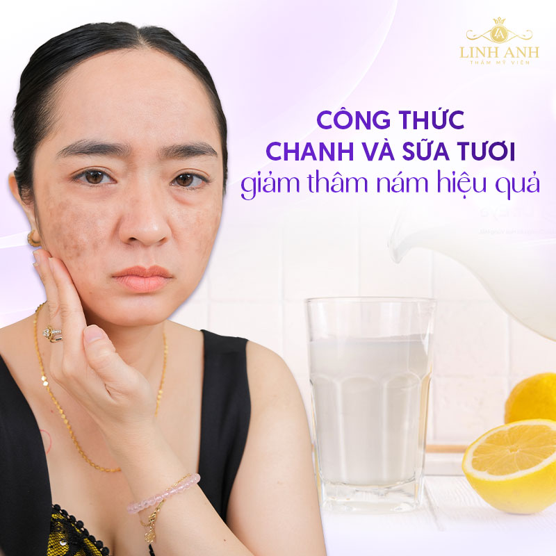 Cách trị nám bằng chanh và sữa tươi