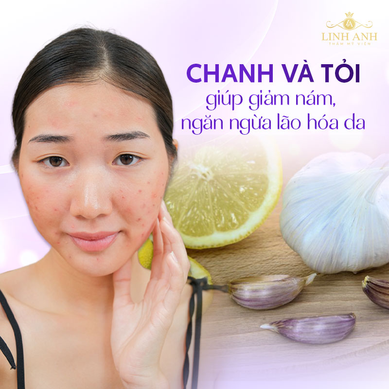 Cách trị nám tại nhà bằng chanh và tỏi