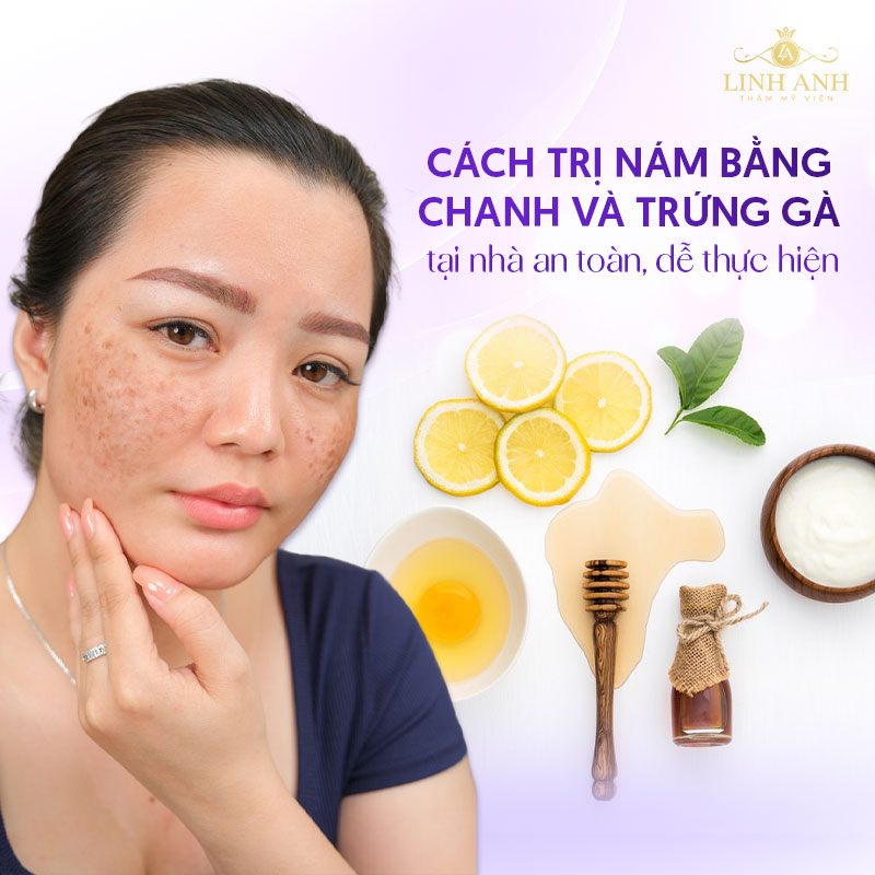 Cách trị nám bằng chanh và trứng gà