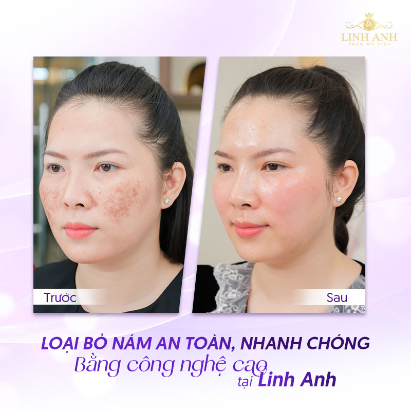 Điều trị nám bằng công nghệ cao