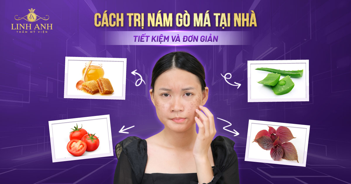 Top 8 cách trị nám gò má tại nhà tiết kiệm và đơn giản