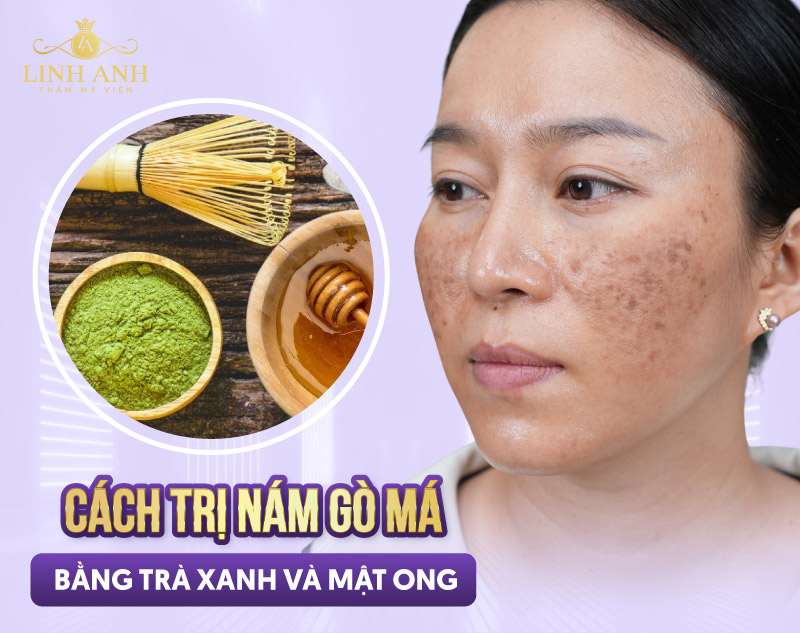 trị nám bằng bột trà xanh kết hợp mật ong