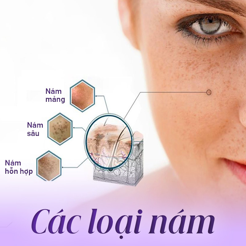 các loại nám da phổ biến