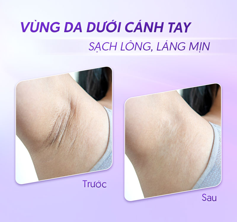cách triệt lông nách tuổi dậy thì cách triệt lông nách tuổi dậy thì