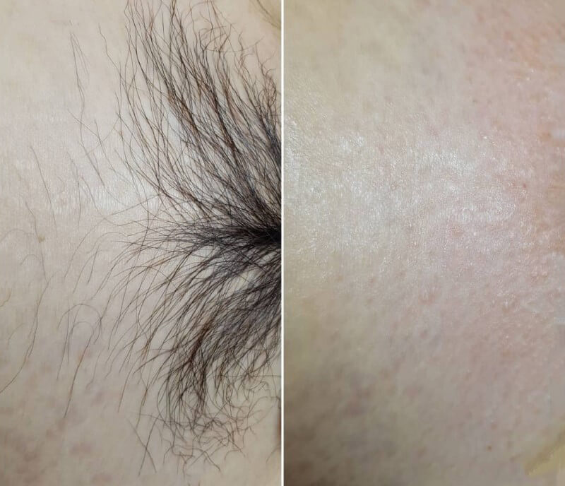 Cạo lông vùng kín theo chiều nào Cạo lông vùng kín nữ an toàn