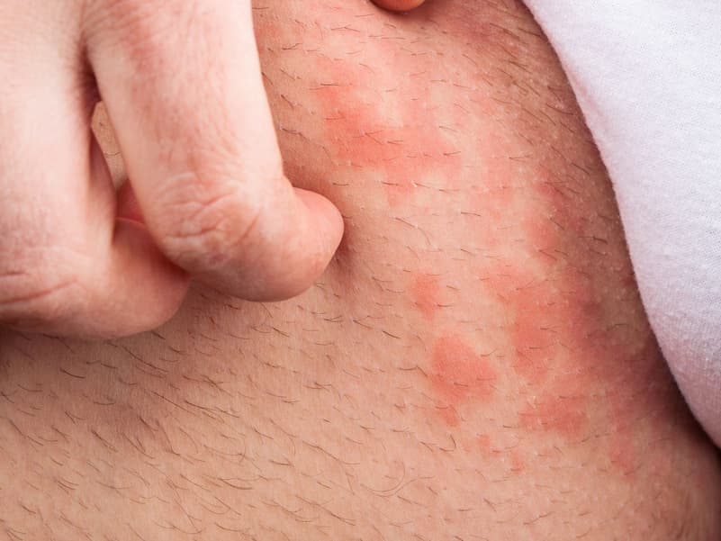 Cạo lông vùng kín xong bị ngứa Cạo lông vùng kín xong bị ngứa