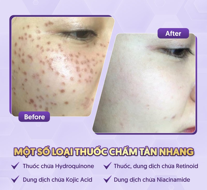dùng thuốc chấm tàn nhang