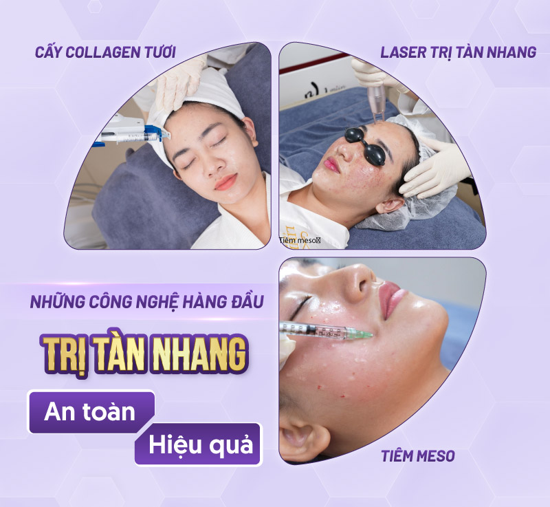 trị tàn nhang bằng công nghệ