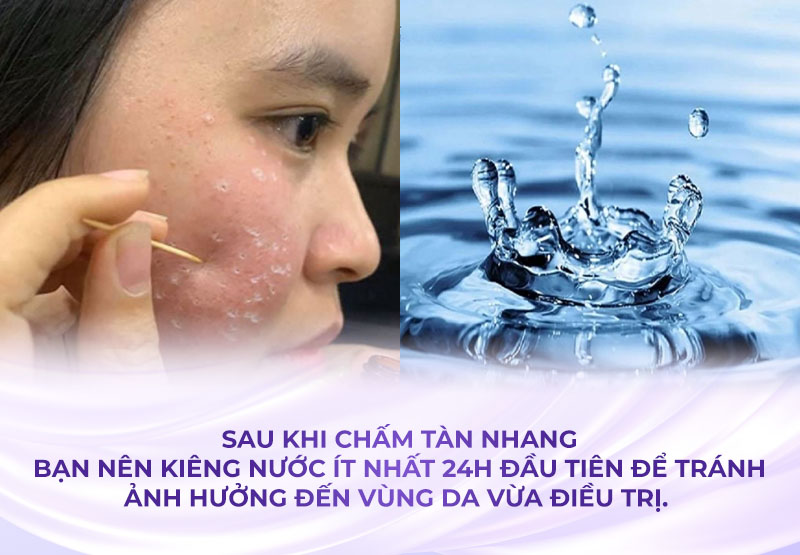bắn tàn nhang nên kiêng nước bao lâu