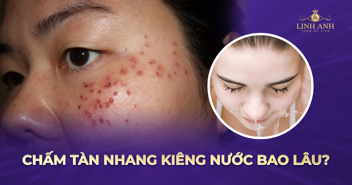 Chấm tàn nhang kiêng nước bao lâu để da nhanh hồi phục?