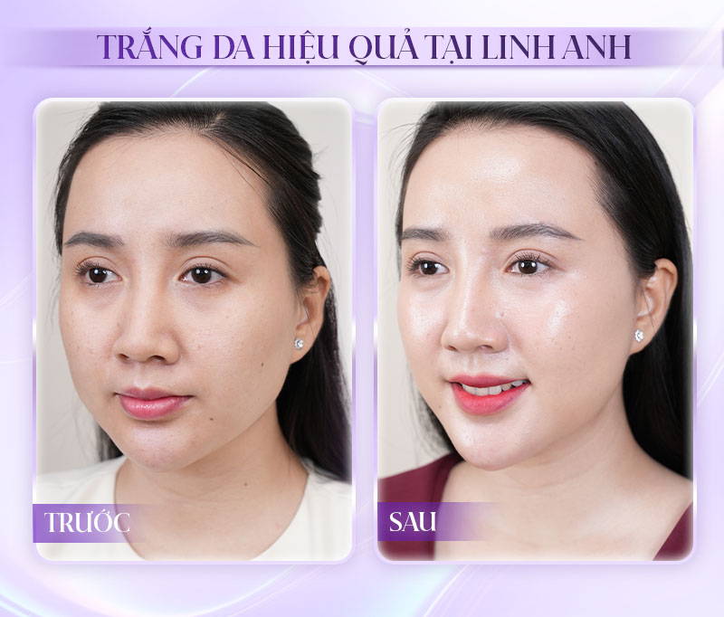 Có nên tiêm meso trắng da không