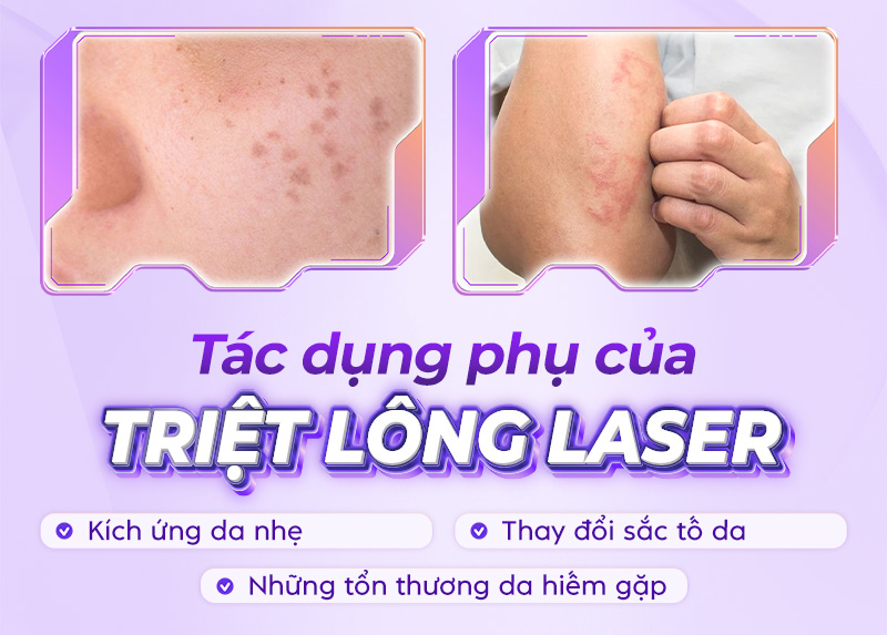 công nghệ triệt lông bằng laser công nghệ triệt lông bằng laser