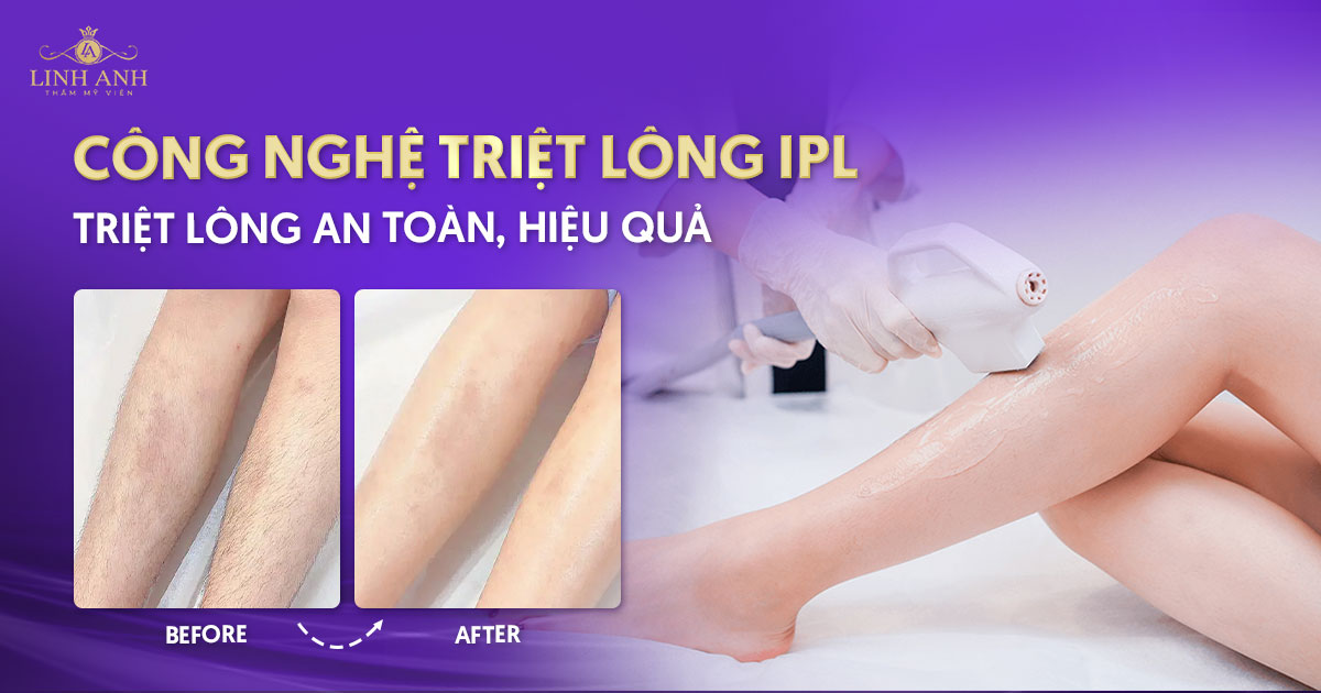 công nghệ triệt lông IPL