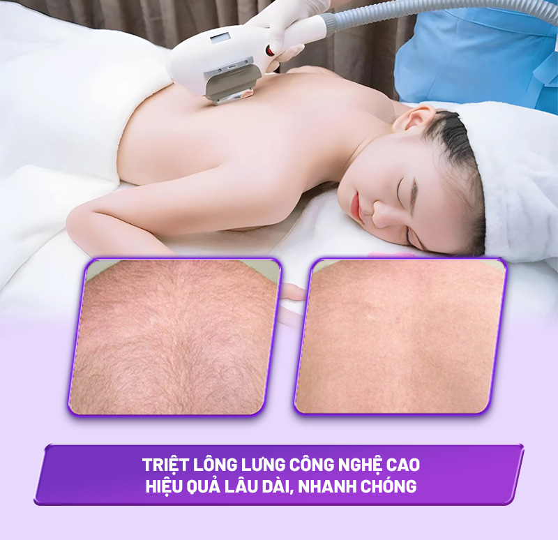 công nghệ triệt lông lưng tốt nhất công nghệ triệt lông lưng tốt nhất