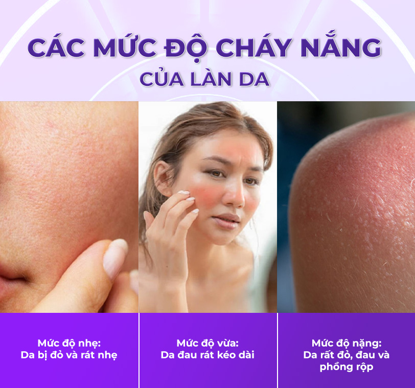 các mức độ da bị cháy nắng