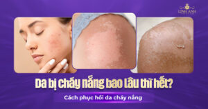 da bị cháy nắng trong bao lâu thì hết