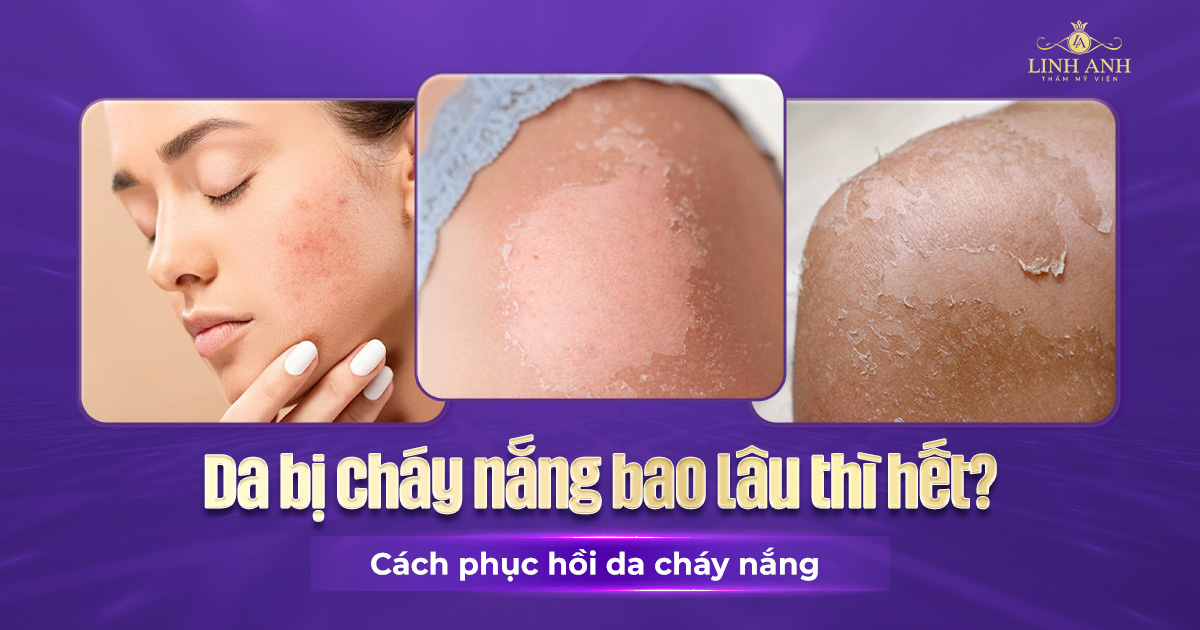 Da bị cháy nắng bao lâu thì hết? Cách phục hồi da cháy nắng