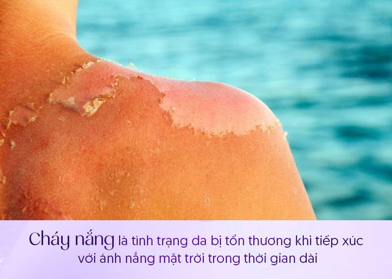 Nám nắng là gì
