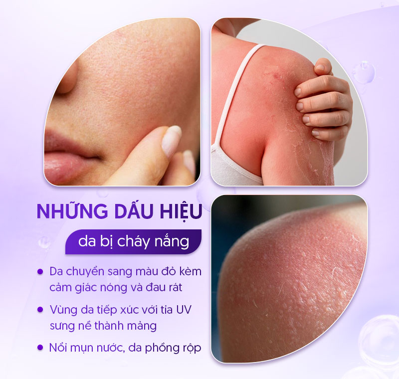 Dấu hiệu da bị cháy nắng sạm đen