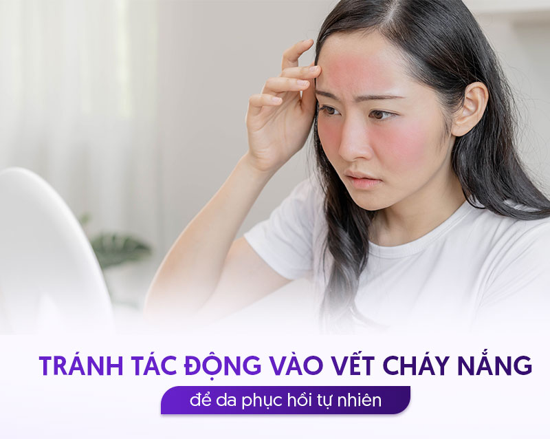 Da bị cháy nắng phải làm sao