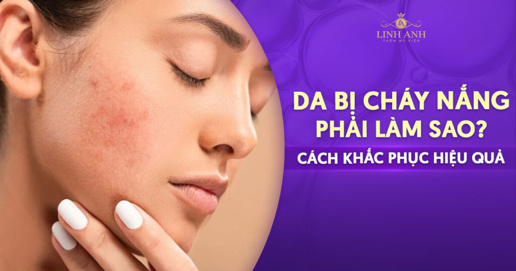 Da bị cháy nắng phải làm sao