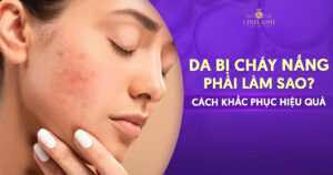 Da bị cháy nắng phải làm sao