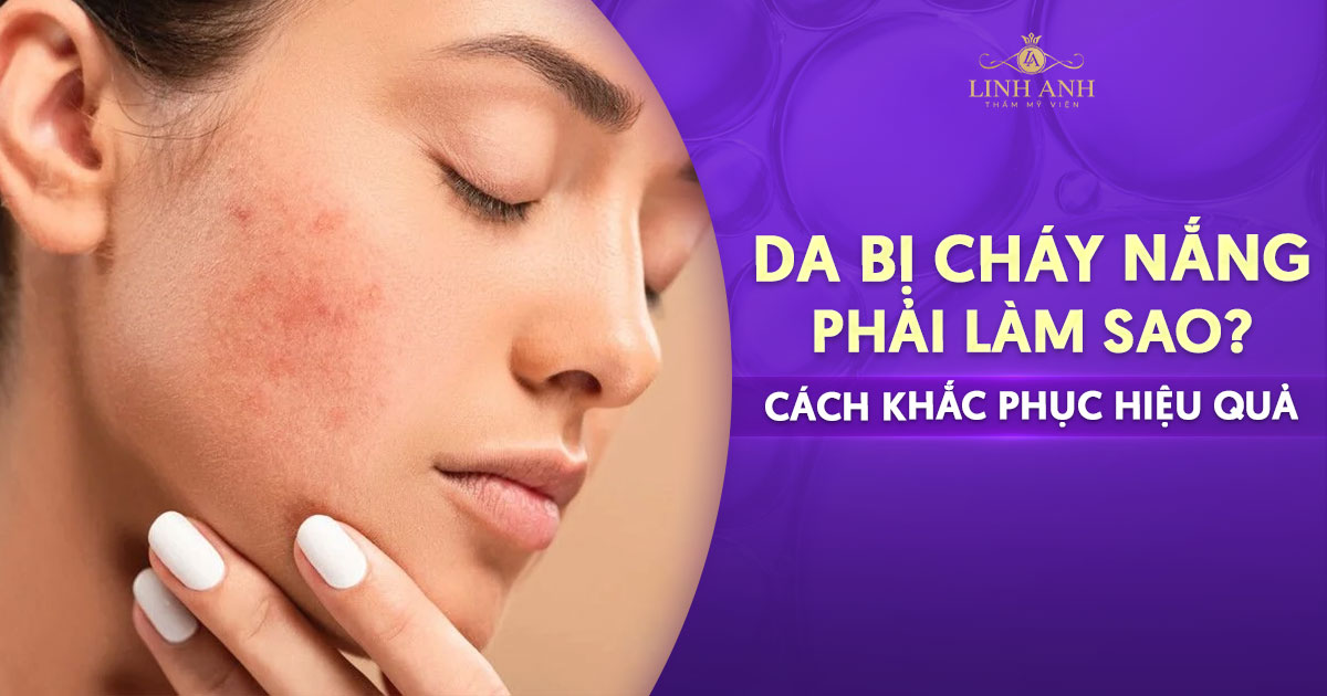 Da bị cháy nắng phải làm sao? 7 cách khắc phục hiệu quả