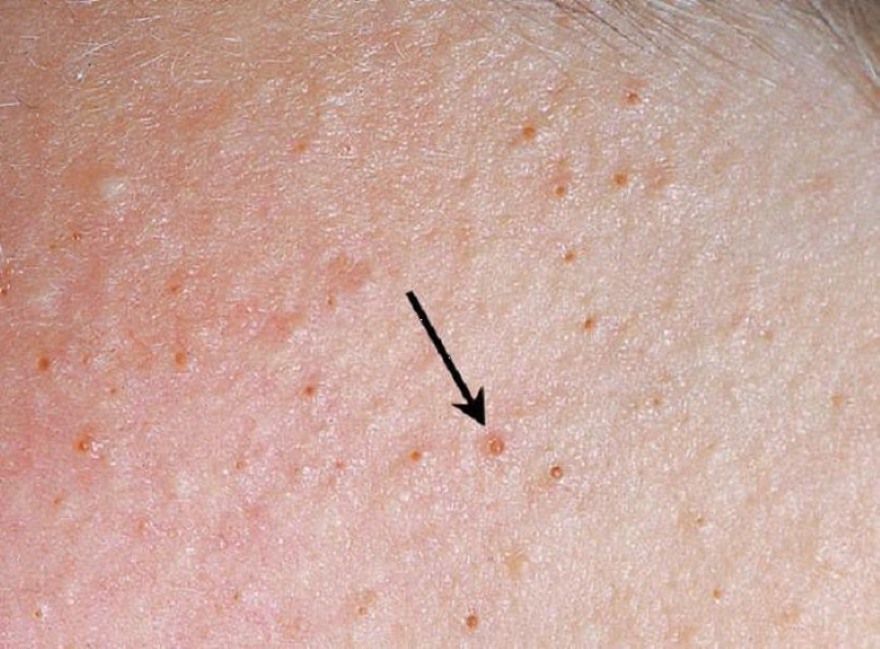 Dấu hiệu lông mọc ngược Dấu hiệu lông mọc ngược