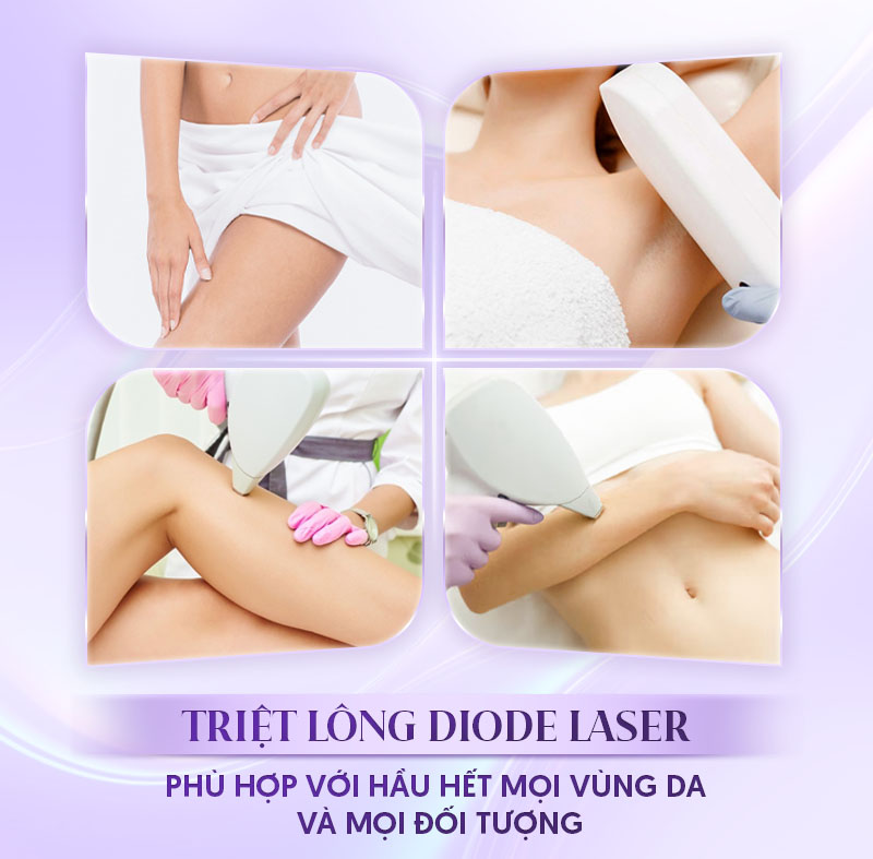 dịch vụ triệt lông diode laser