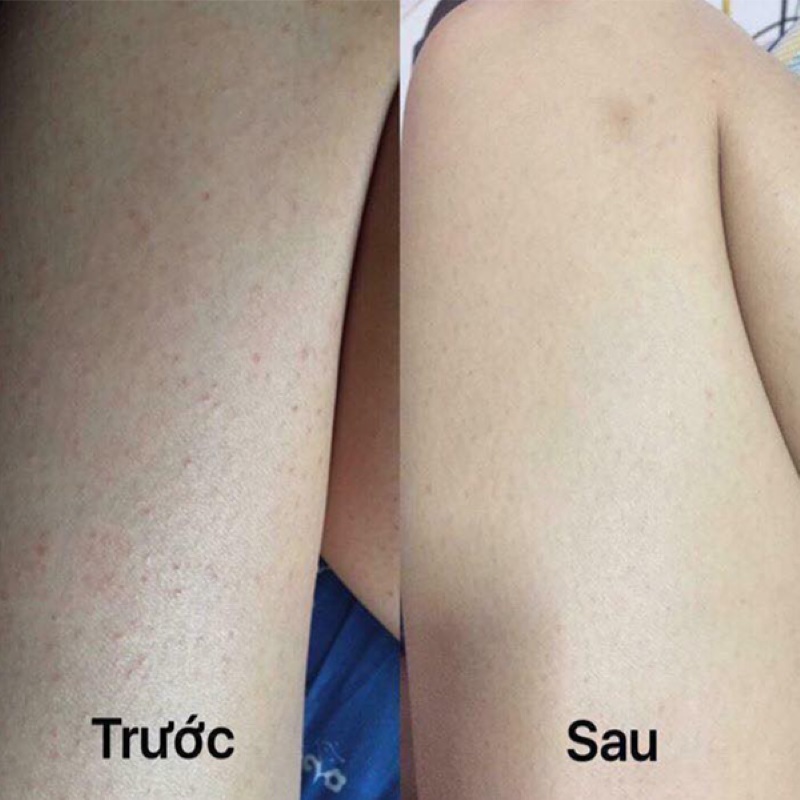 Điều trị lông mọc ngược bằng Laser
