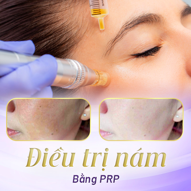 Phương pháp PRP cải thiện tình trạng nám da hiệu quả