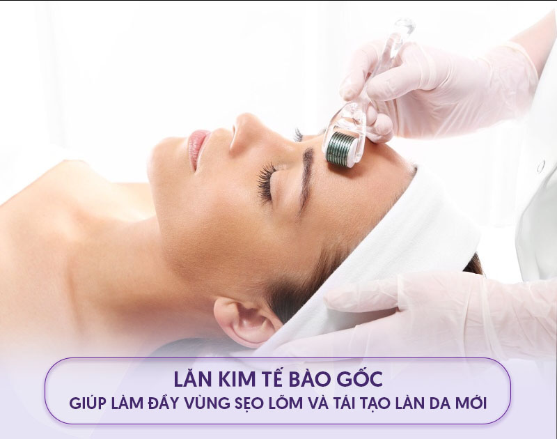 lăn kim tế bào gốc