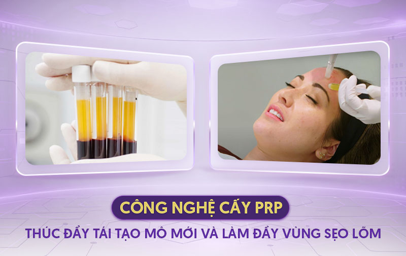 sử dụng công nghệ PRP