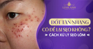 đốt tàn nhang có để lại sẹo không
