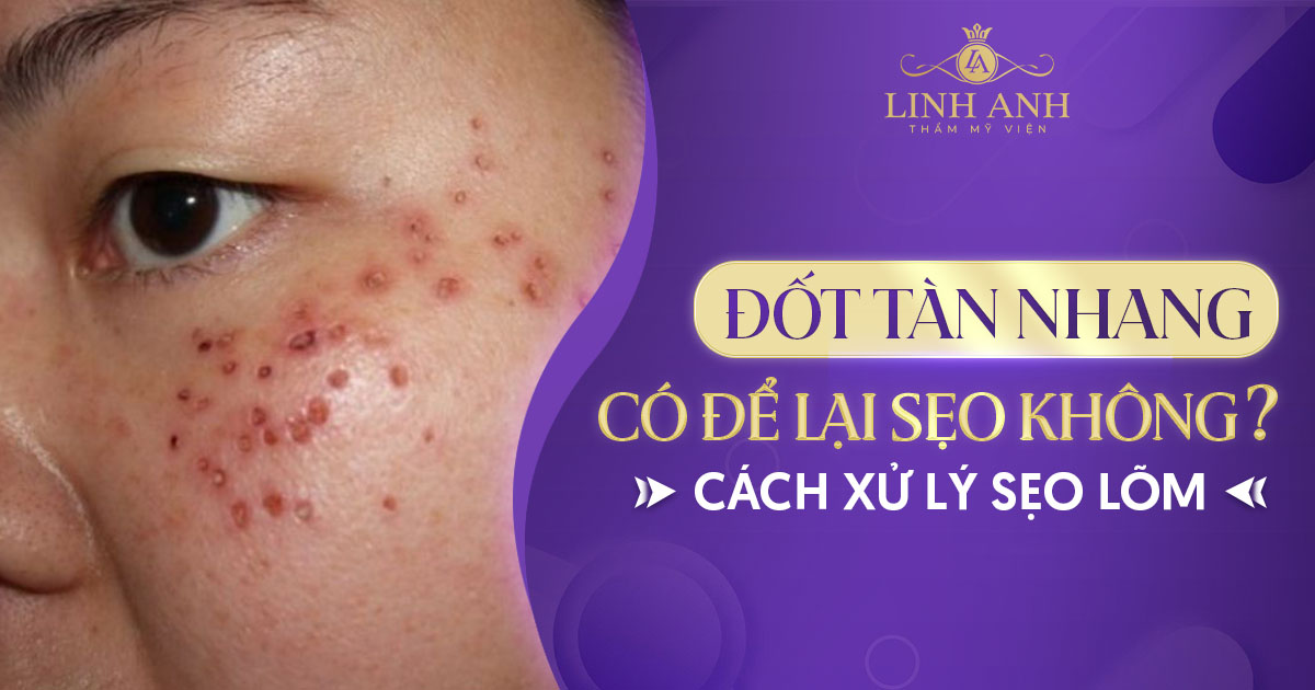 Đốt tàn nhang có để lại sẹo không? Cách xử lý nếu bị sẹo lõm