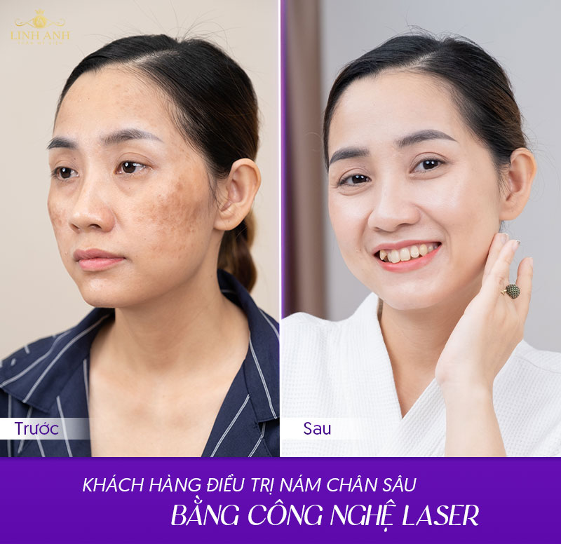 công nghệ laser điều trị nám