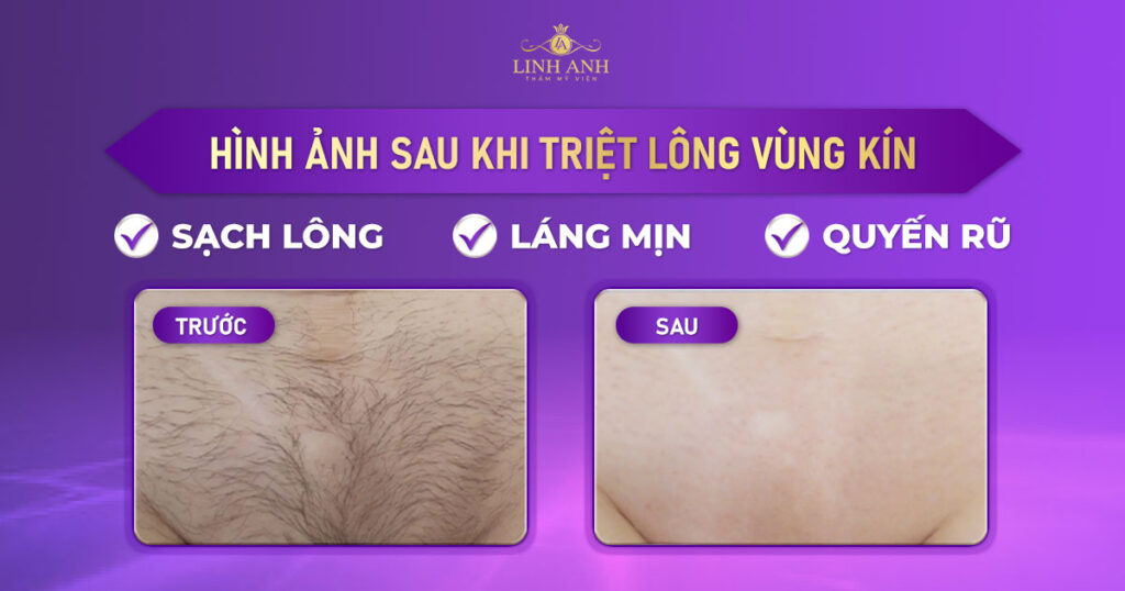 hình ảnh sau khi triệt lông vùng kín
