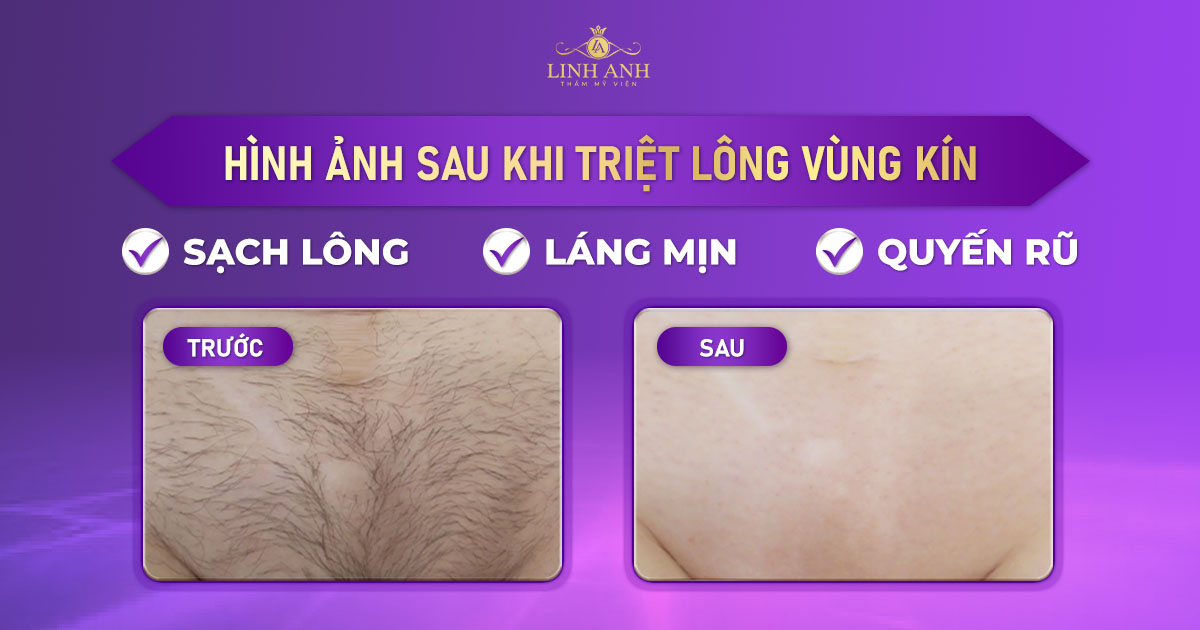 hình ảnh sau khi triệt lông vùng kín