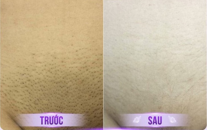 hình ảnh sau triệt lông bikini