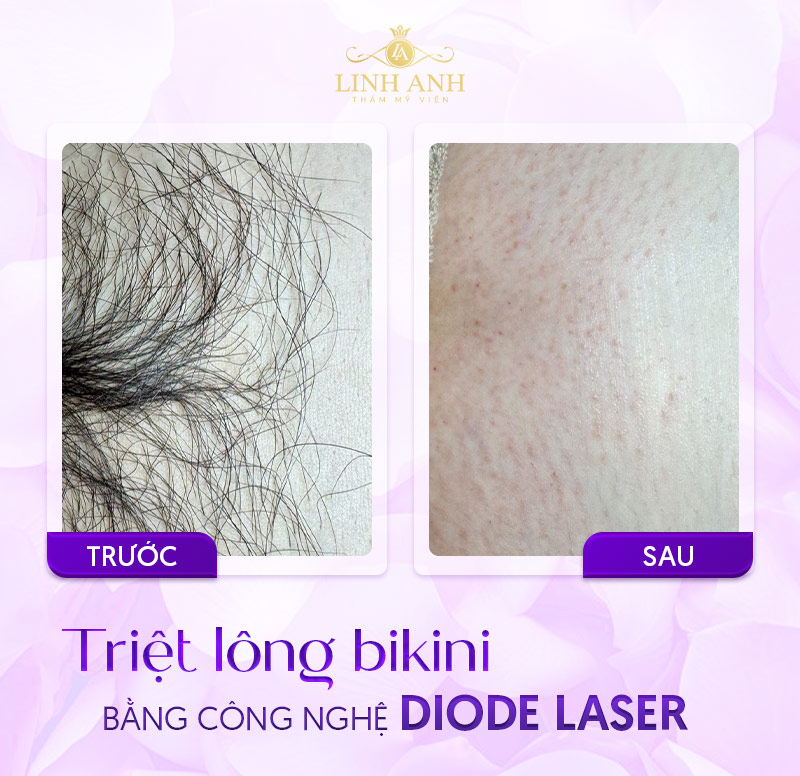 Hình ảnh triệt lông Bikini