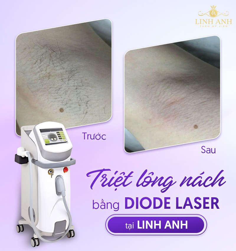 Hình ảnh triệt lông nách Diode Laser